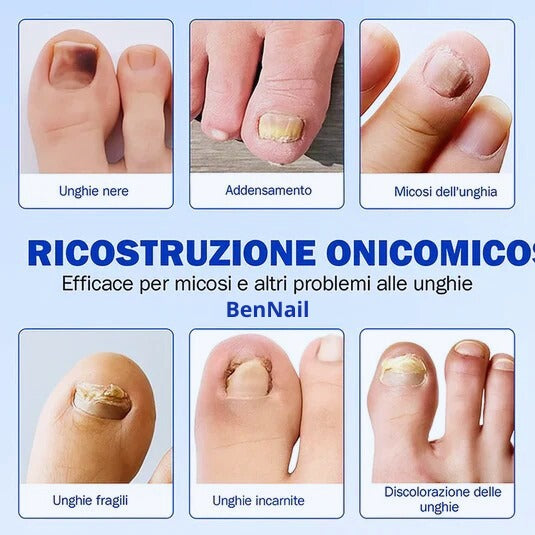 BenNail Patch Antifungo.