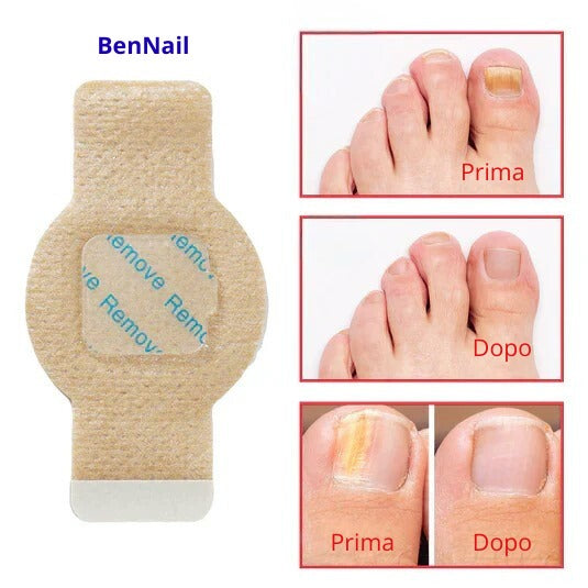 BenNail Patch Antifungo.