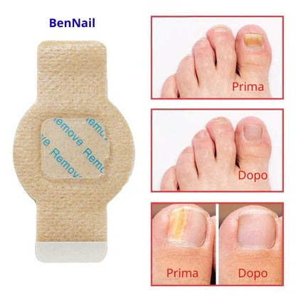 BenNail Patch Antifungo.